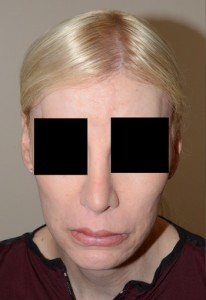 Miami, Fl Transgender Photo - Patient 1 - After 1