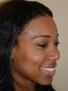 Miami, Fl Hairline Advancement Photo - Patient 1 - After 1