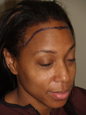 hairline advancement - patient 41 - before 1