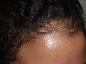 follicular unit micrografting - patient 5 - before 3