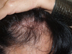 follicular unit micrografting  - patient 91 - before 2