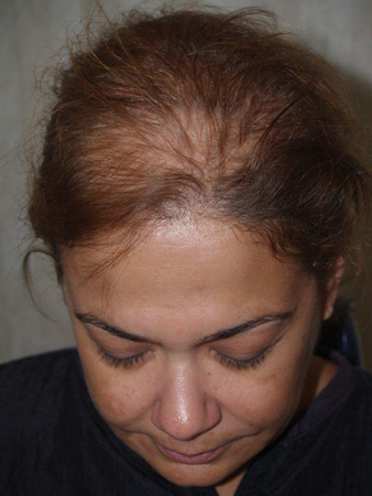 follicular unit micrografting - patient 92 - before 1
