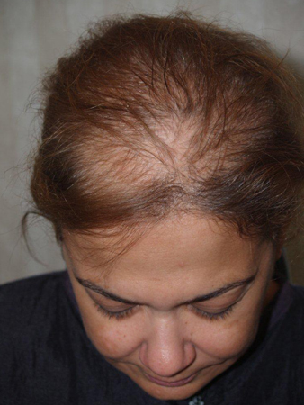follicular unit micrografting - patient 92 - before 2