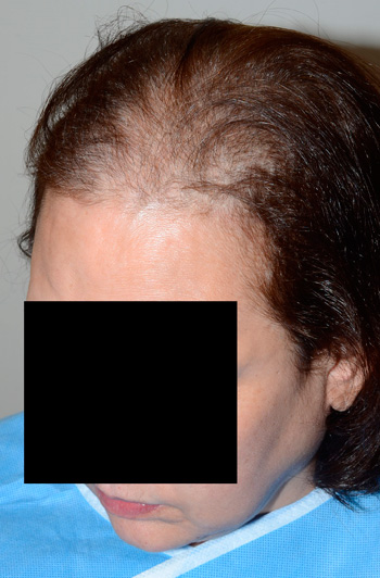 follicular unit micrografting - patient 101 - before 2