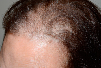 follicular unit micrografting - patient 101 - before 4