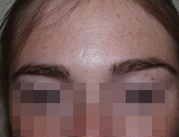 eyebrow transplant - patient 3 - after 1