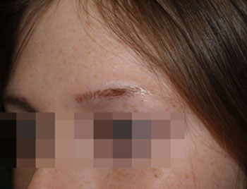 eyebrow transplant - patient 3 - before 3