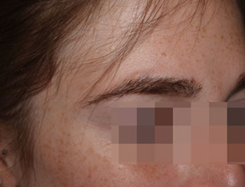 eyebrow transplant - patient 3 - after 2