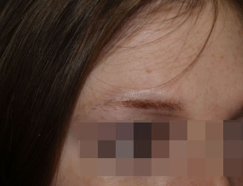 eyebrow transplant - patient 3 - before 2