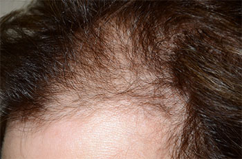 follicular unit micrografting - patient 1 - before 3