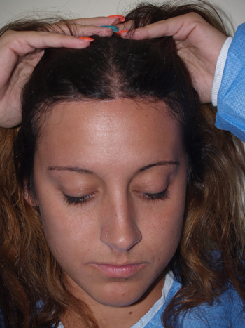 hairline advancement - patient 7 - after 1