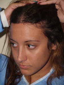 Miami, Fl Hairline Advancement Photo - Patient 1 - After 2