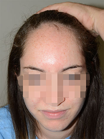 hairline advancement - patient 6 - before 1