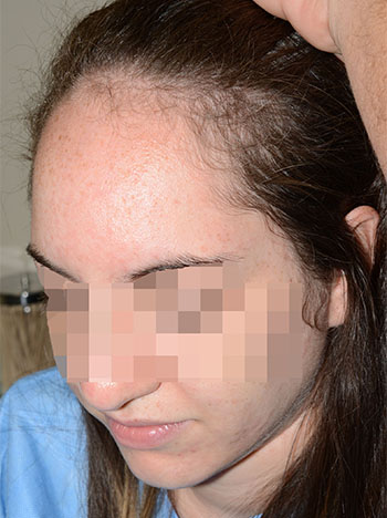 hairline advancement - patient 6 - before 3