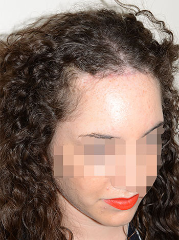 hairline advancement - patient 6 - after 2
