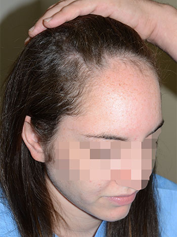 hairline advancement - patient 6 - before 2