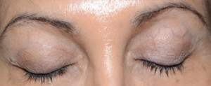 Miami, Fl. Eyebrow Transplant Photo - Patient 1 - Before 1