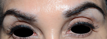 eyebrow transplant - patient 61 - after 3