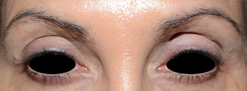 eyebrow transplant - patient 61 - before 3