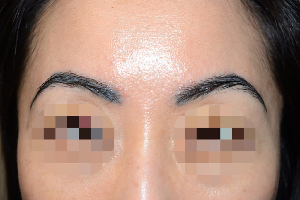eyebrow transplant - patient 7 - after 1