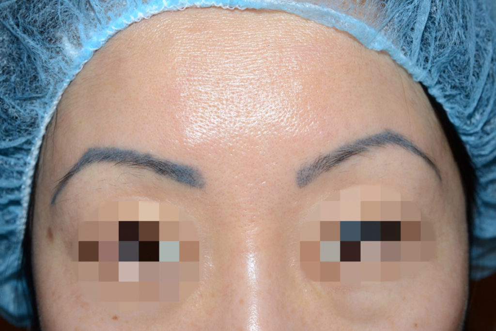 eyebrow transplant - patient 7 - before 1