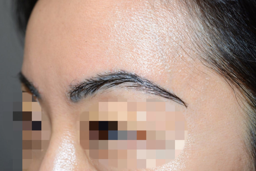 eyebrow transplant - patient 7 - after 3