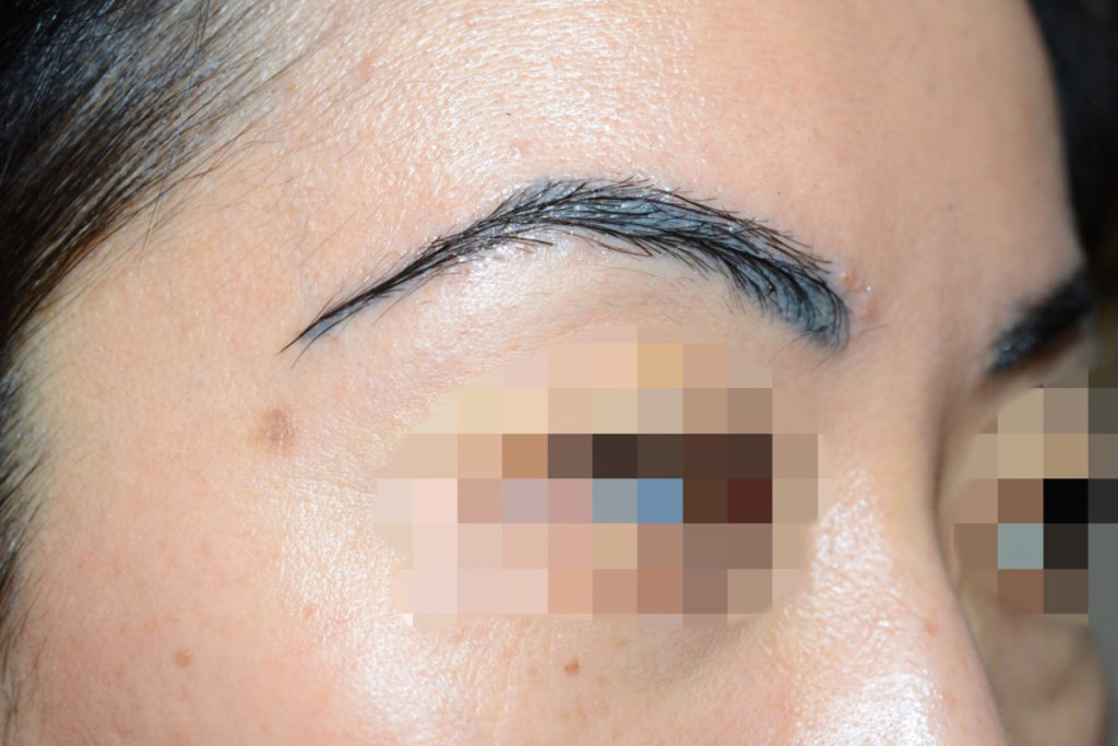 eyebrow transplant - patient 7 - after 2