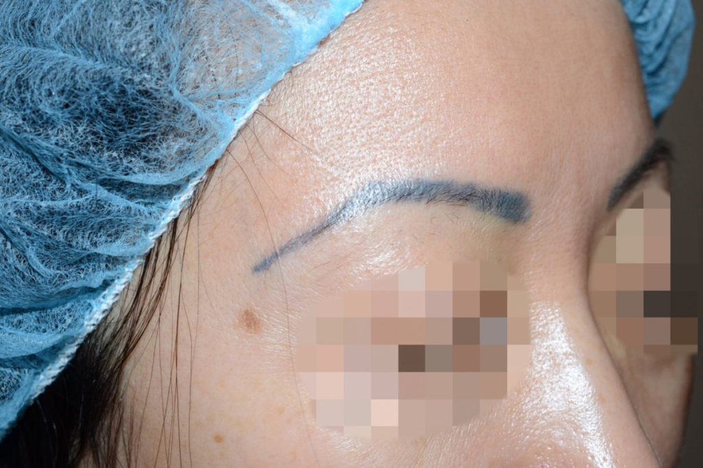 eyebrow transplant - patient 7 - before 2