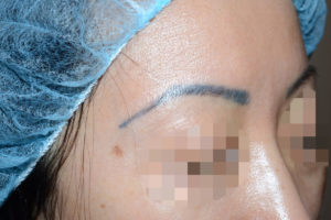 Miami, Fl. Eyebrow transplant Photo - Patient 1 - Before 2