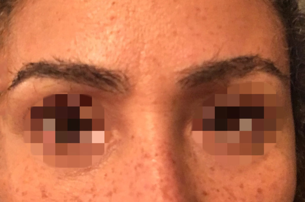 eyebrow transplant - patient 20 - after 1