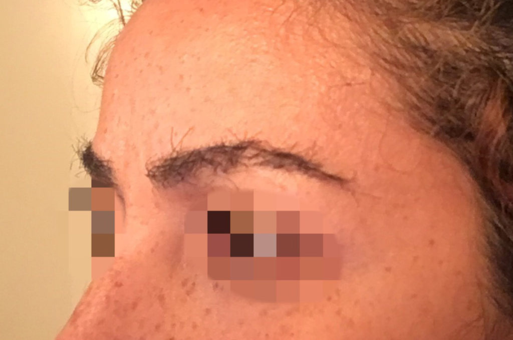 eyebrow transplant - patient 20 - after 3