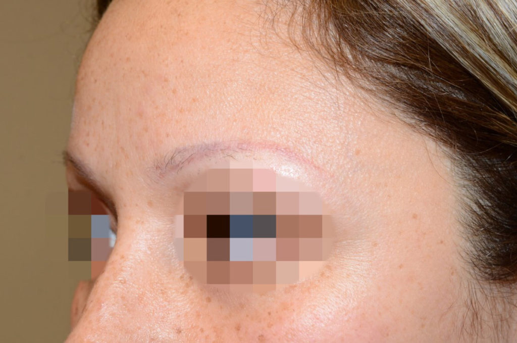 eyebrow transplant - patient 20 - before 3