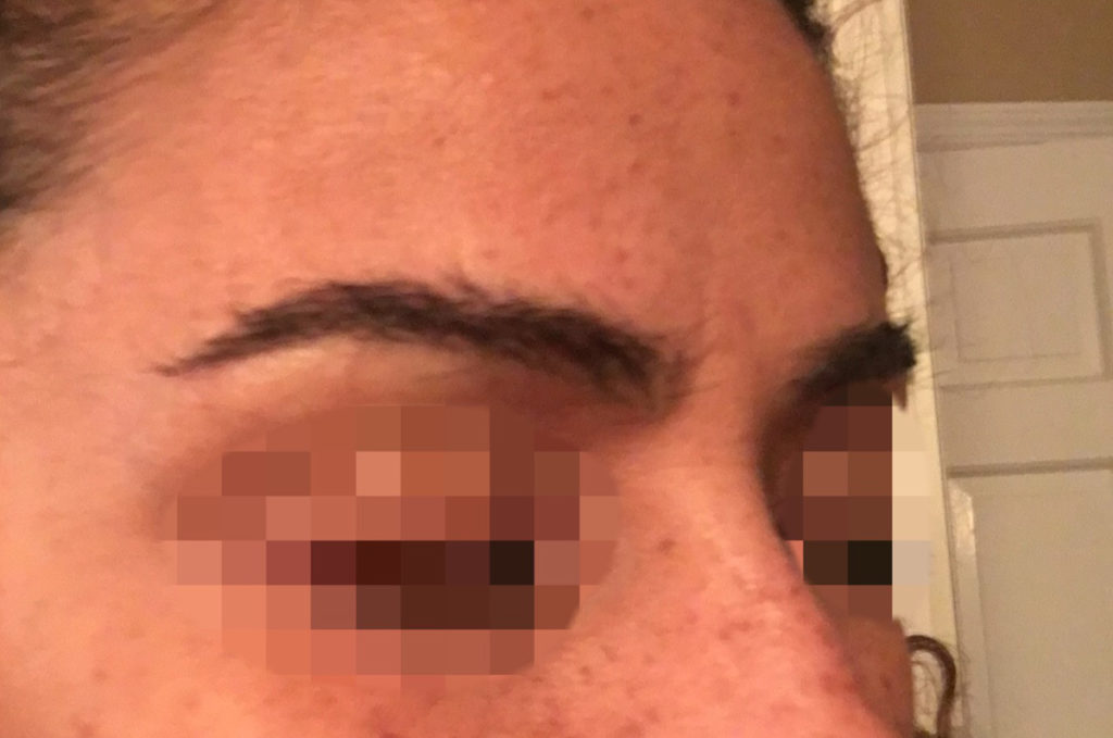 eyebrow transplant - patient 20 - after 2