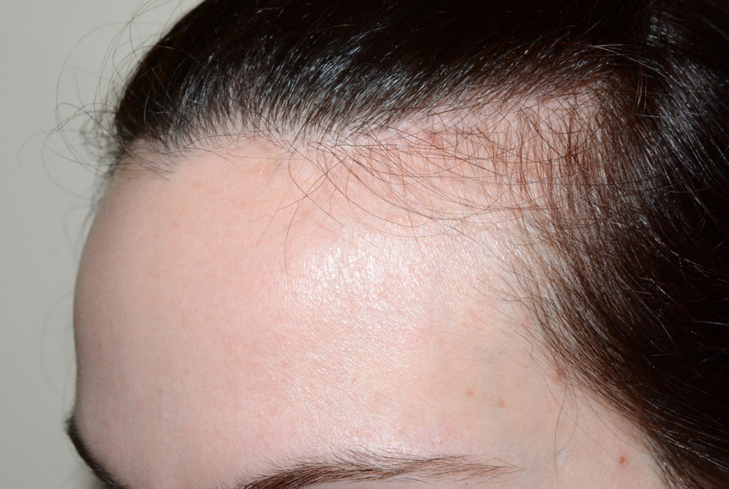 hairline advancement - patient 4 - before 2