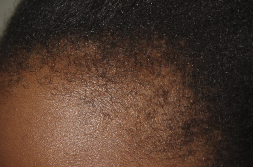 hairline advancement - patient 45 - before 1