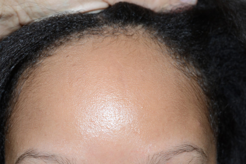 hairline advancement - patient 2 - before 1