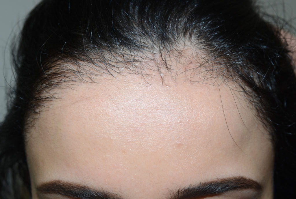 hairline advancement - patient 3 - after immediately 2
