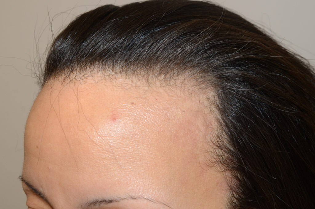 hairline advancement - patient 1 - before 3
