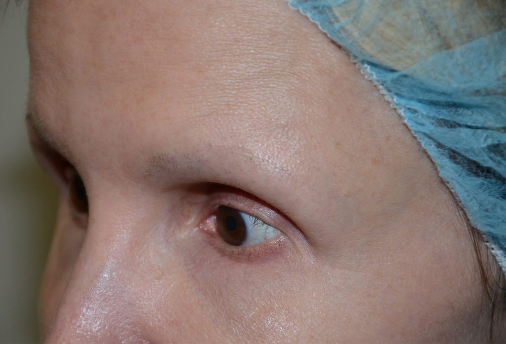 eyebrow transplant - patient 1 - before 1