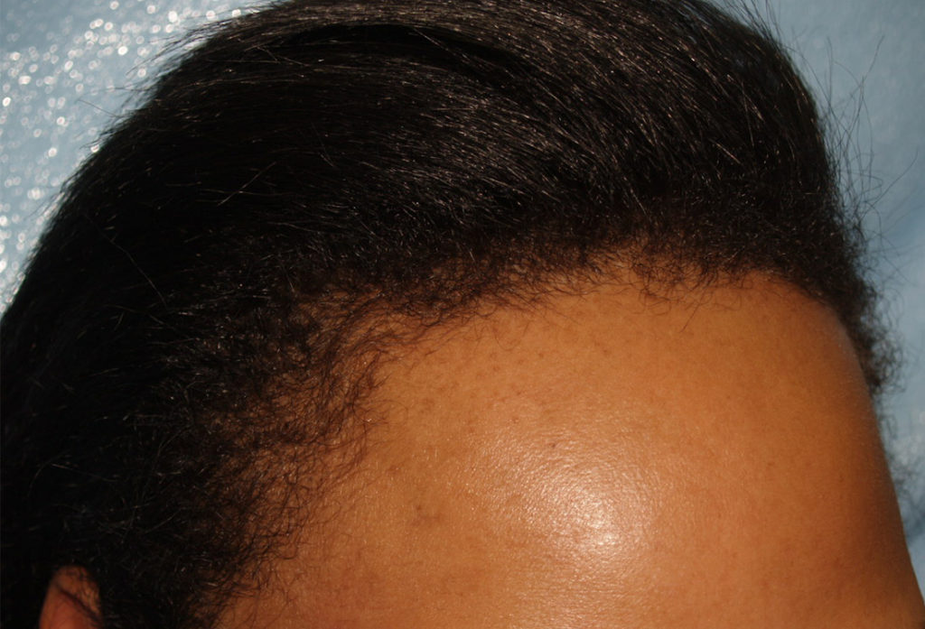 hairline advancement - patient 1 - before 1
