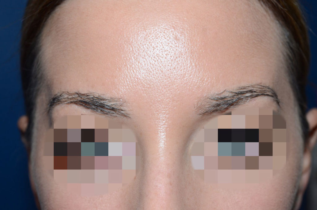 eyebrow transplant - patient 130 - after 1