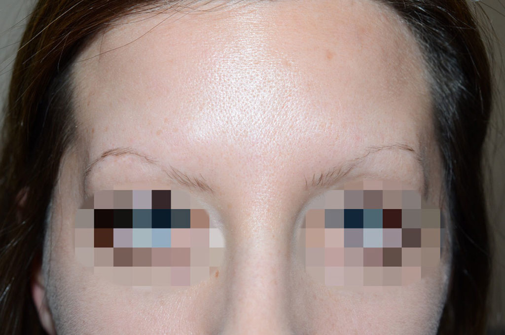 eyebrow transplant - patient 130 - before 1