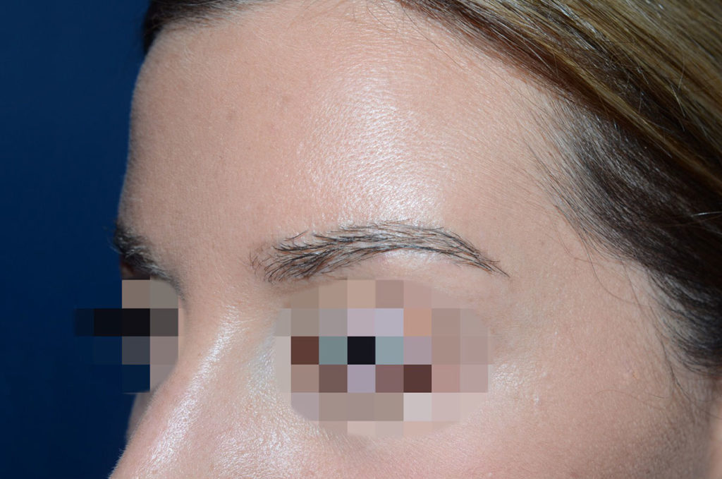 eyebrow transplant - patient 130 - after 2