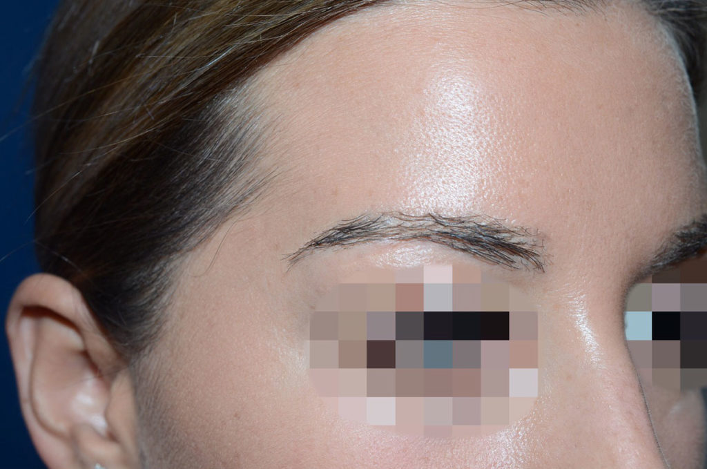 eyebrow transplant - patient 130 - after 3