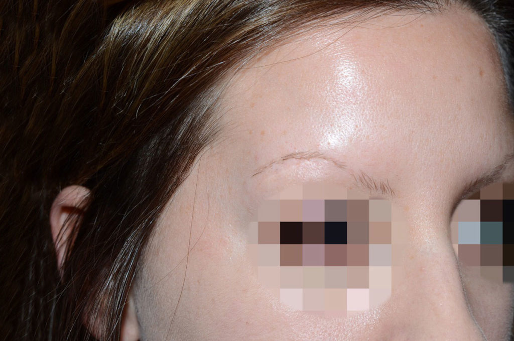 eyebrow transplant - patient 130 - before 3