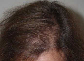 hairline advancement - patient 1 - after 2