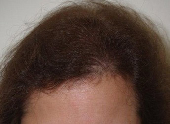 hairline advancement - patient 1 - after 3
