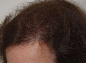 hairline advancement - patient 1 - after 1