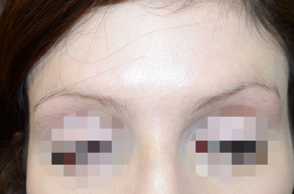 eyebrow transplant - patient 131 - before 1