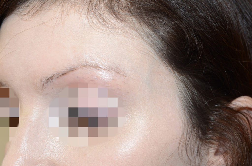 eyebrow transplant - patient 131 - before 2